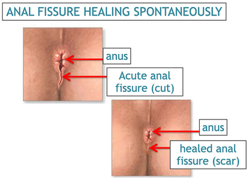 fissure skin