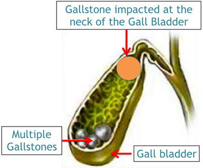 eswl gallstones