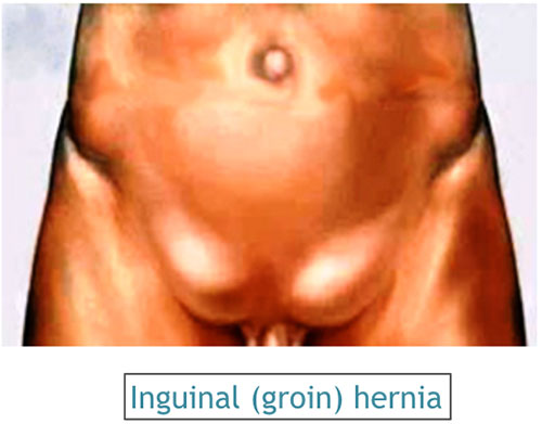 Inguinal (Groin) Hernia Repair Surgery