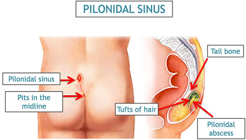 Pilonidal Sinus Disease (Pilonidal Cyst) - Dermatology Advisor