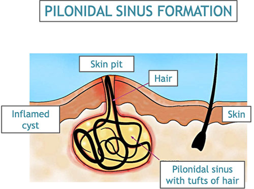 Pilonidal Sinus and Pilonidal Cyst