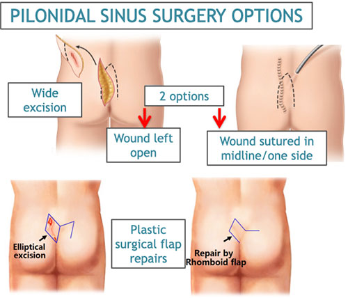 Pilonidal sinus: Symptoms, pictures, and treatment