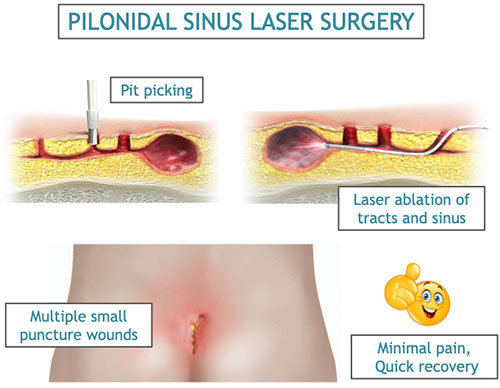 Pilonidal sinus treatment  Laser surgery for pionidal sinus